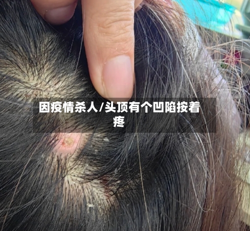 因疫情杀人/头顶有个凹陷按着疼-第2张图片